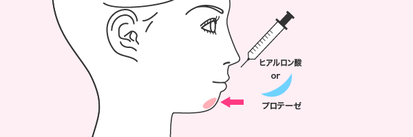 顎形成（ヒアルロン酸／プロテーゼ）