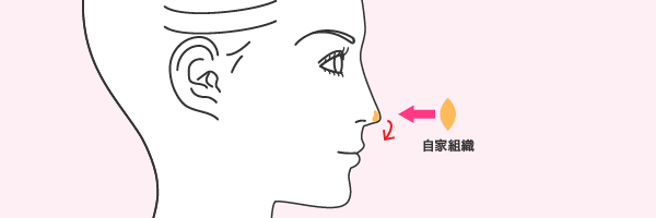 鼻中隔延長術（びちゅうかくえんちょう）