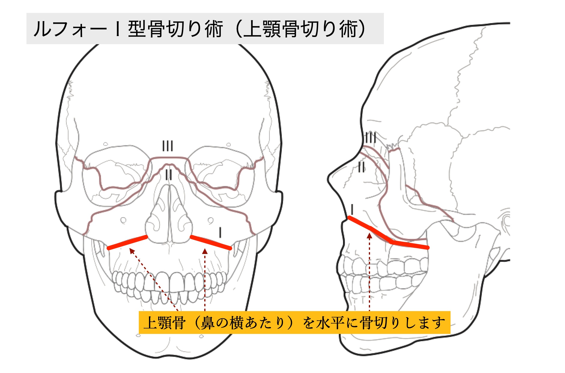 ルフォーＩ型骨切り術（上顎骨切り術）