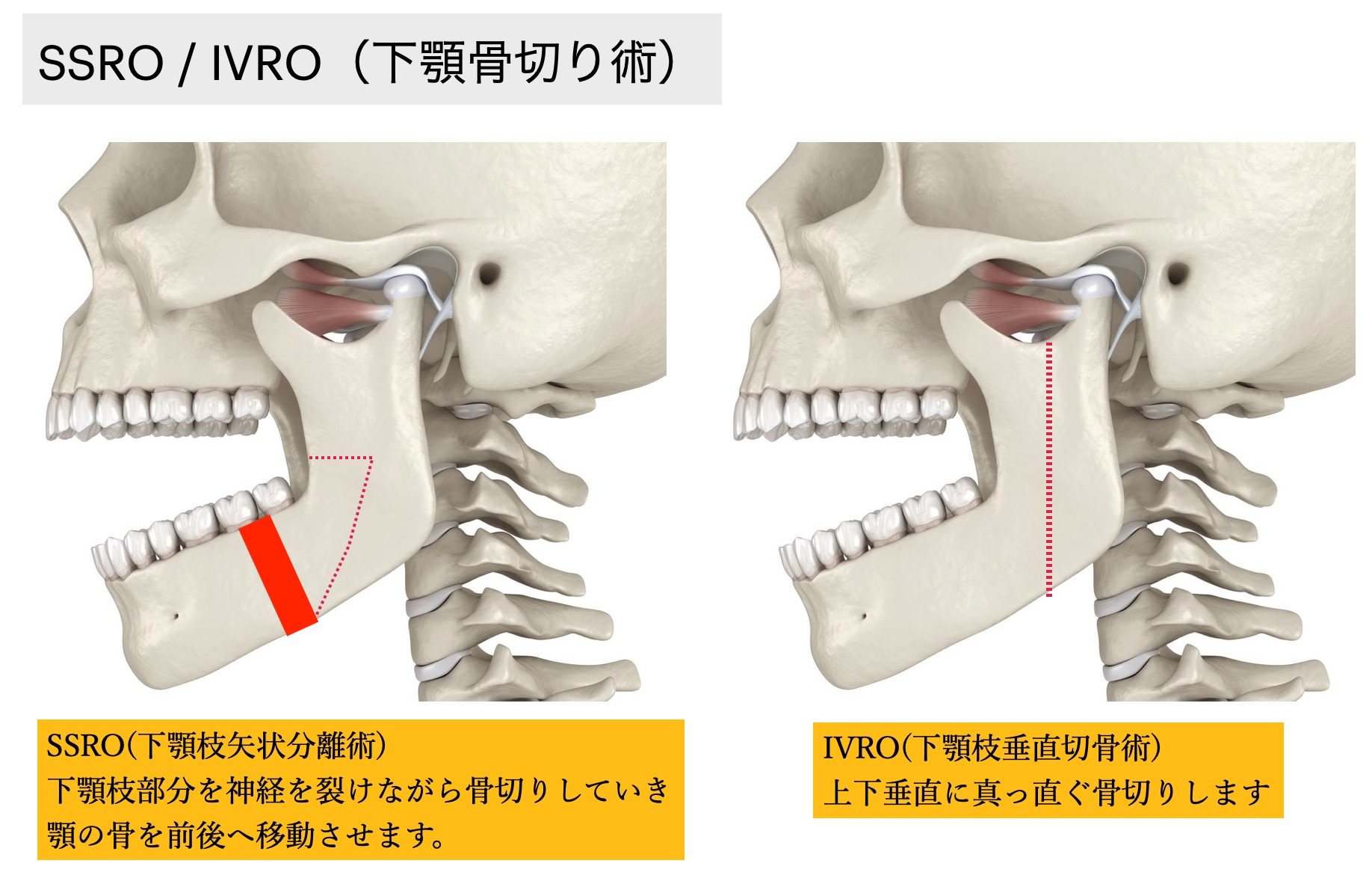 SSRO / IVRO（下顎骨切り術）