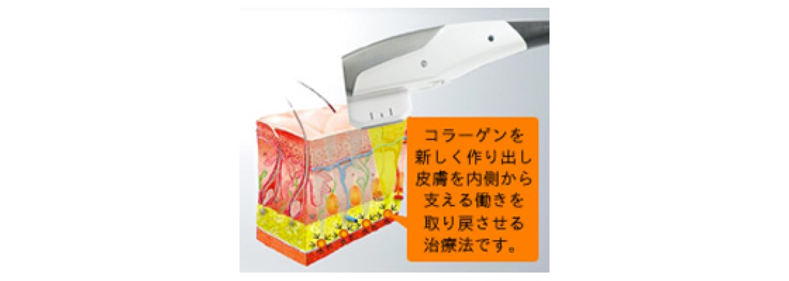 サーマル　高周波　リフトアップ ボルニューマ - 世界最先端のエイジングケアを提供するTHE ONE.(ザ