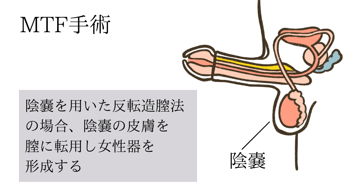 性転換ニューハーフ　女性器 性転換 - 新宿の美容外科・整形｜しらゆりビューティークリニック