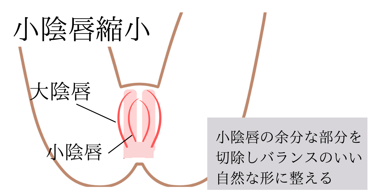 小陰唇縮小