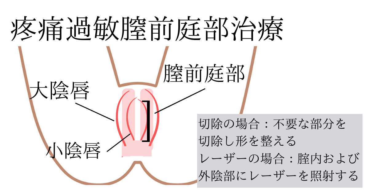 疼痛過敏膣前庭部治療