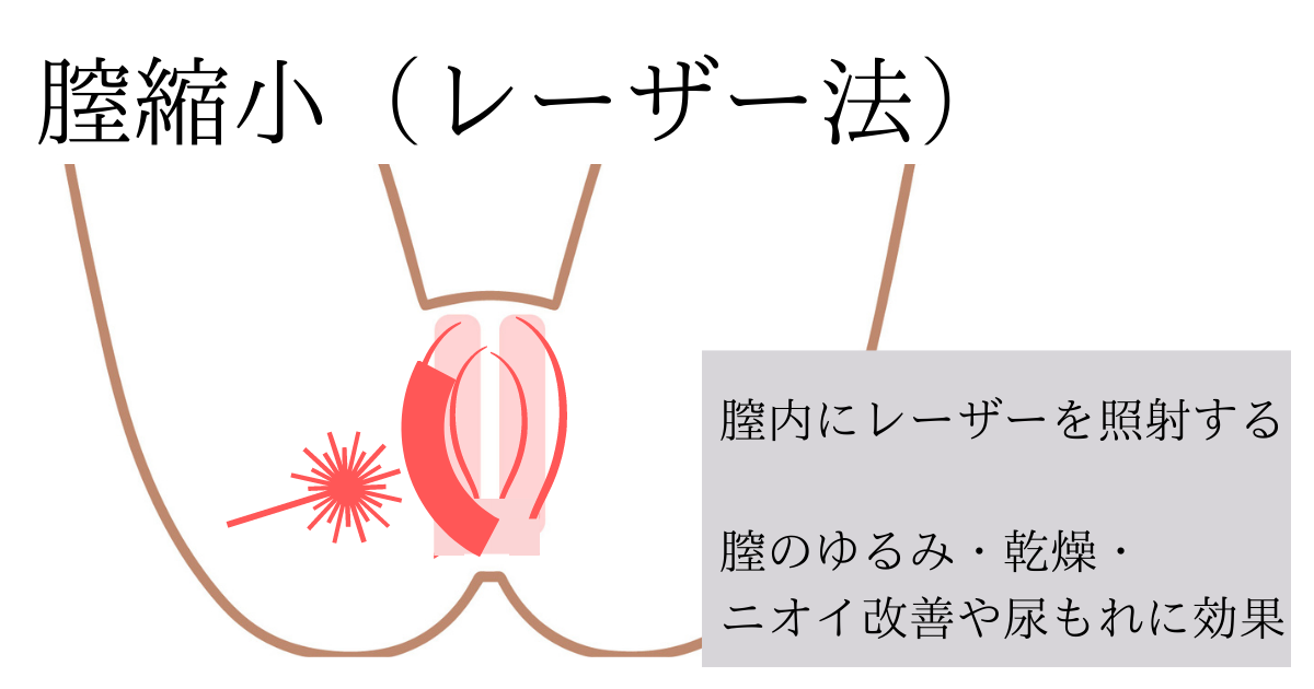 膣縮小（レーザー法）